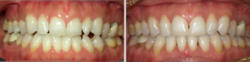 Edge to Edge Bite, Missing Tooth, Midline Discrepancy﻿