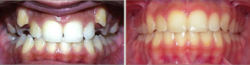 Narrow Upper Jaw, Ectopic Canines