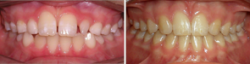 Impaction & Multiple Missing Teeth﻿