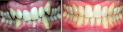 Severe Crowding, Recession, Canted Upper Teeth